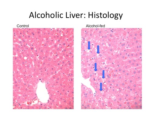Alcoholic Fatty Liver